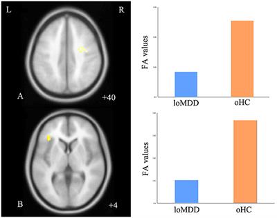 The Influence of Myelin Oligodendrocyte Glycoprotein on White Matter Abnormalities in Different Onset Age of Drug-Naïve Depression